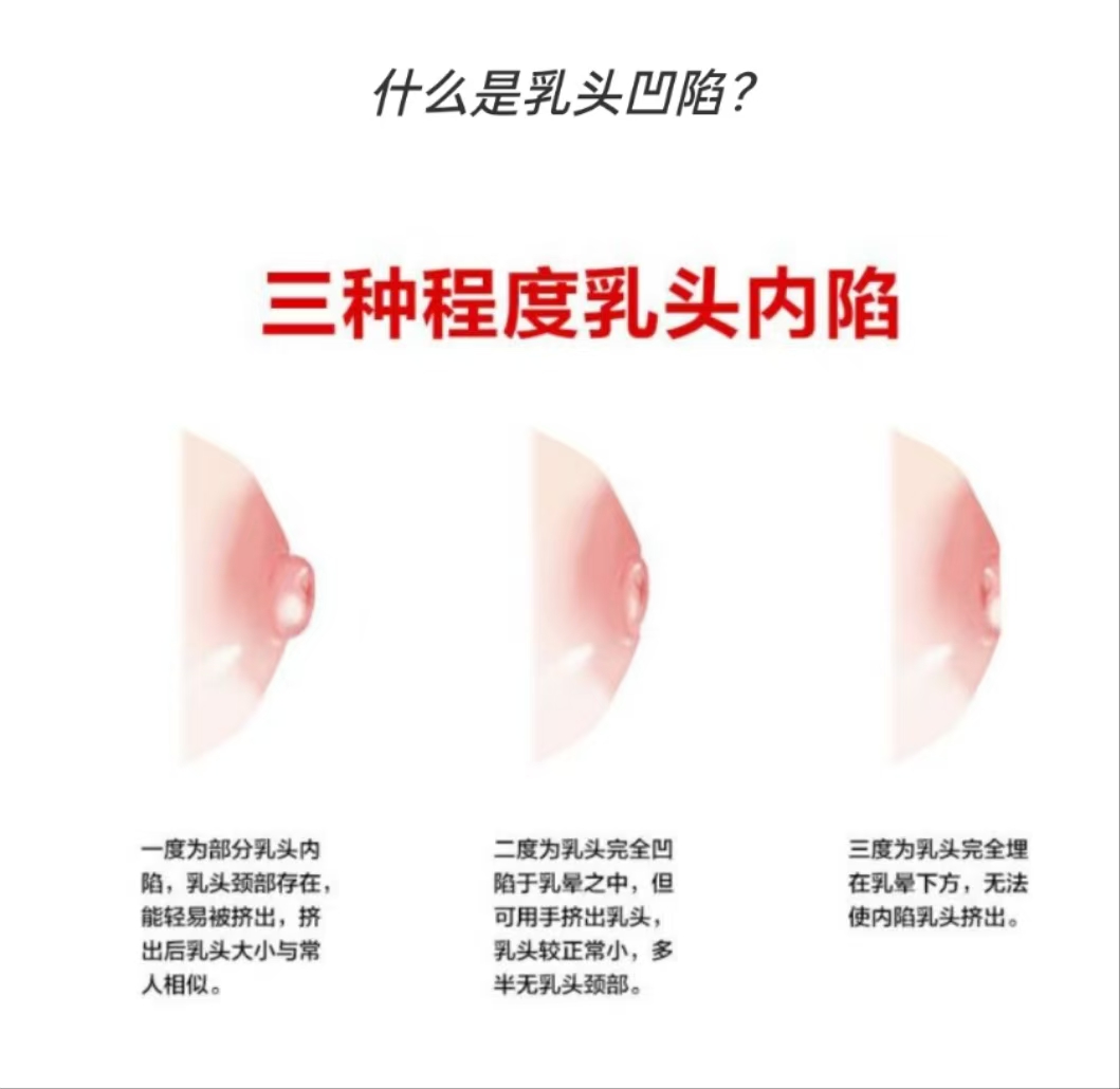 乳頭凹陷的媽媽該如何哺乳？