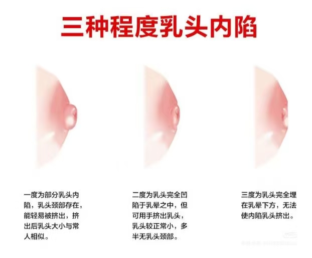 乳頭凹陷的媽媽該如何哺乳？